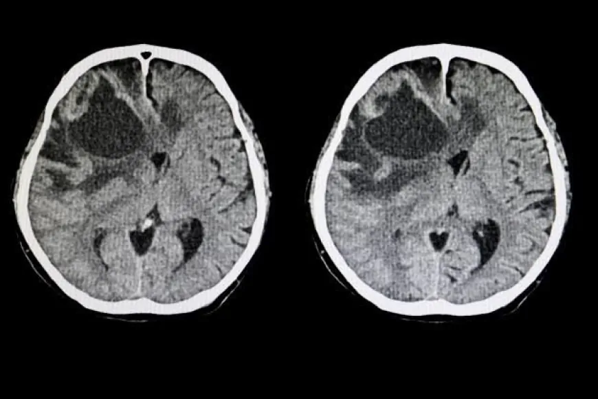 ilustrasi-ct-scan-tumor-otak.webp